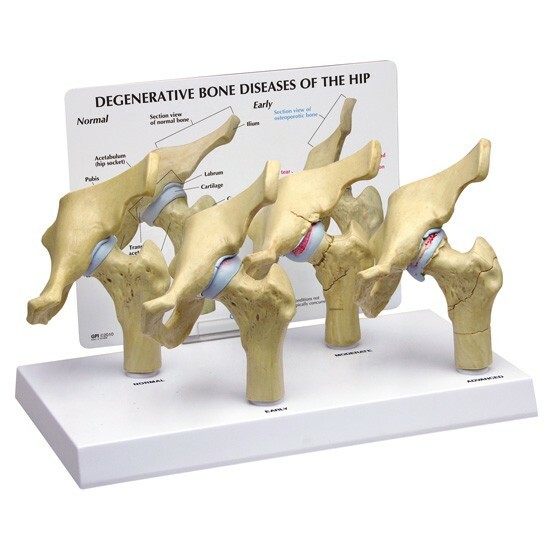 Hip 4-stage Osteoarthritis Disease Anatomical Model GPI LFA #1320 See VIDEO!