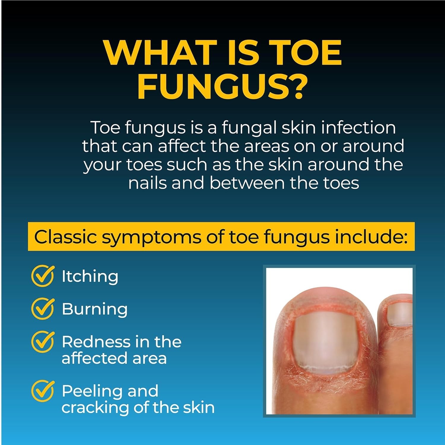 Fungi Nail Anti-Fungal Ointment 0.7 Fl Oz, Kills Fungus That Can Lead to Athlete