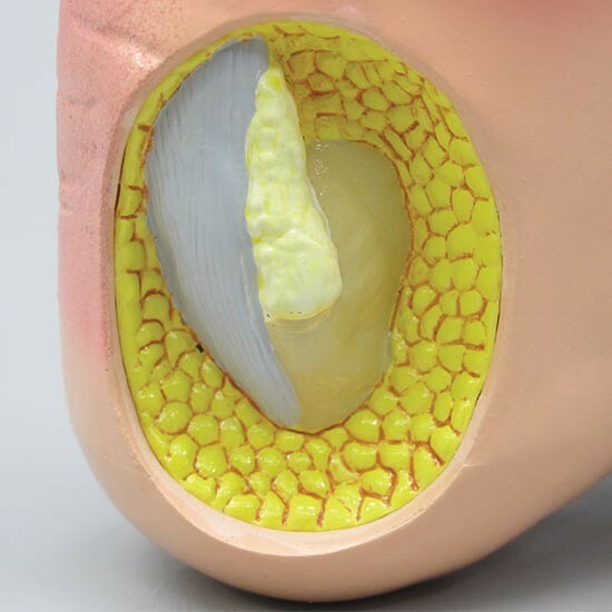 Foot Anatomical Model Gout Tophi GPI LFA #1985 SEE VIDEO