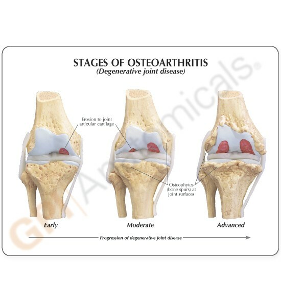 Knee 4-stage Osteoarthritis Anatomical Model LFA #1100 SEE VIDEO. Make An Offer!