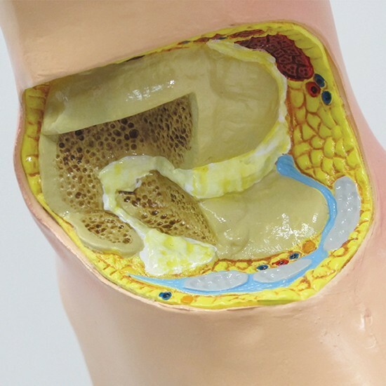 Foot Anatomical Model Gout Tophi GPI LFA #1985 SEE VIDEO