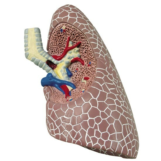 Lung Diseased COPD Cancer Anatomical Model GPI LFA #3110 SEE VIDEO