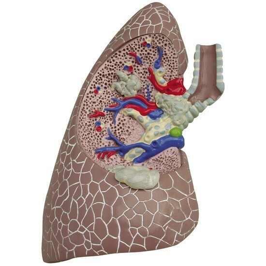 Lung Diseased COPD Cancer Anatomical Model GPI LFA #3110 SEE VIDEO