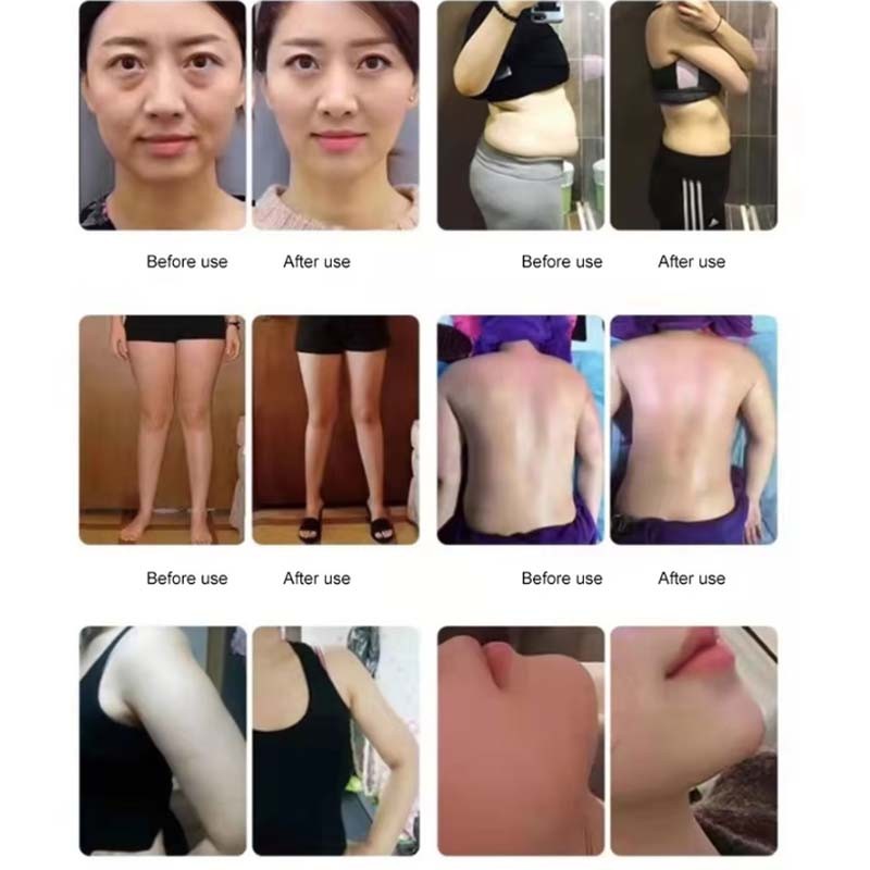 Ret Cet 448khz Tecar Therapy Physiotherapy Body Cellulite Fat Slim Machine