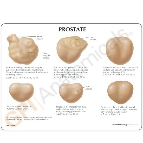 Prostate Gland Anatomical Model Set of Six GPI LFA #3000 SEE VIDEO