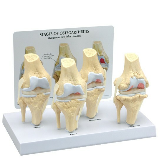 Knee 4-stage Osteoarthritis Anatomical Model LFA #1100 SEE VIDEO. Make An Offer!