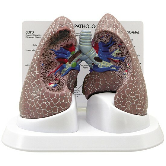 Lung Diseased COPD Cancer Anatomical Model GPI LFA #3110 SEE VIDEO