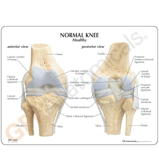 Knee 4-stage Osteoarthritis Anatomical Model LFA #1100 SEE VIDEO. Make An Offer!