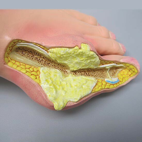 Foot Anatomical Model Gout Tophi GPI LFA #1985 SEE VIDEO