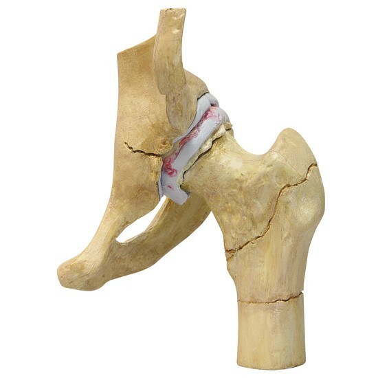 Hip 4-stage Osteoarthritis Disease Anatomical Model GPI LFA #1320 See VIDEO!