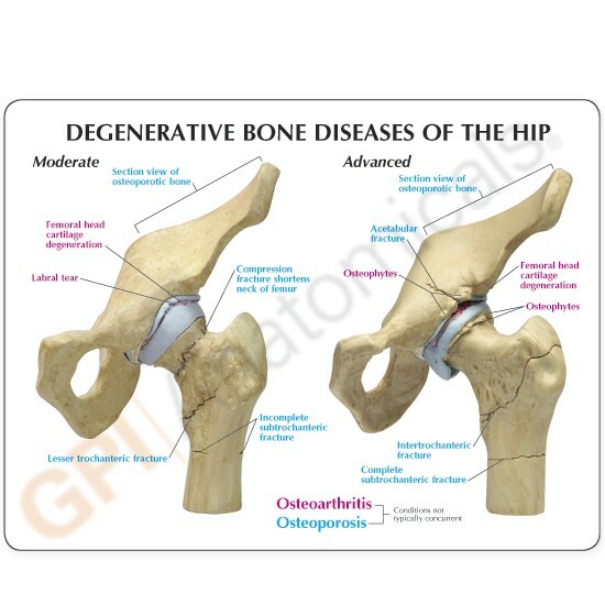 Hip 4-stage Osteoarthritis Disease Anatomical Model GPI LFA #1320 See VIDEO!