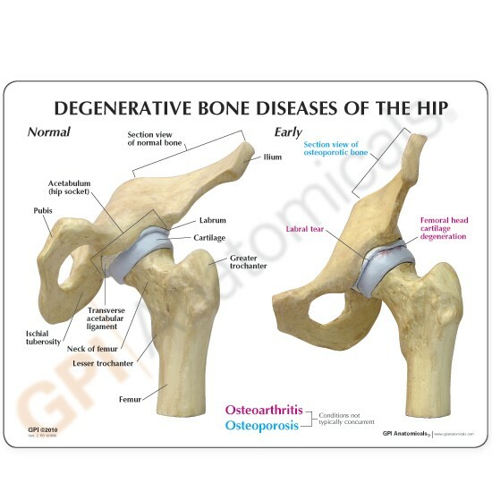 Hip 4-stage Osteoarthritis Disease Anatomical Model GPI LFA #1320 See VIDEO!