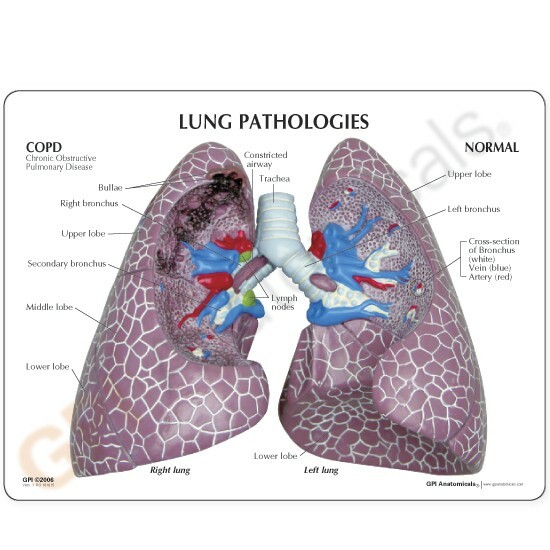 Lung Diseased COPD Cancer Anatomical Model GPI LFA #3110 SEE VIDEO