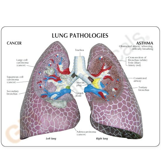 Lung Diseased COPD Cancer Anatomical Model GPI LFA #3110 SEE VIDEO