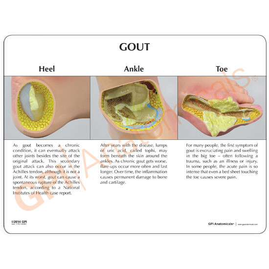 Foot Anatomical Model Gout Tophi GPI LFA #1985 SEE VIDEO