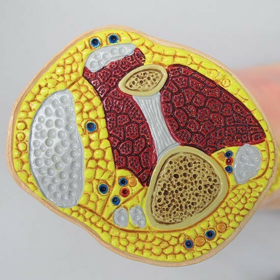 Foot Anatomical Model Gout Tophi GPI LFA #1985 SEE VIDEO