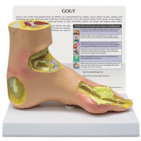 Foot Anatomical Model Gout Tophi GPI LFA #1985 SEE VIDEO