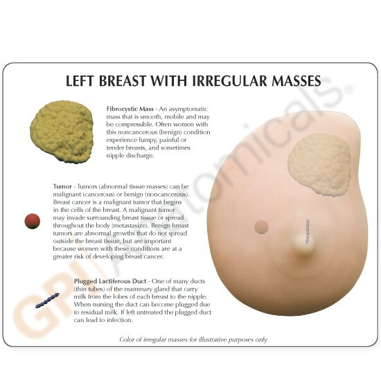 Breast Female Self Exam Soft w Masses Anatomical Model GPI LFA #3401 SEE VIDEO
