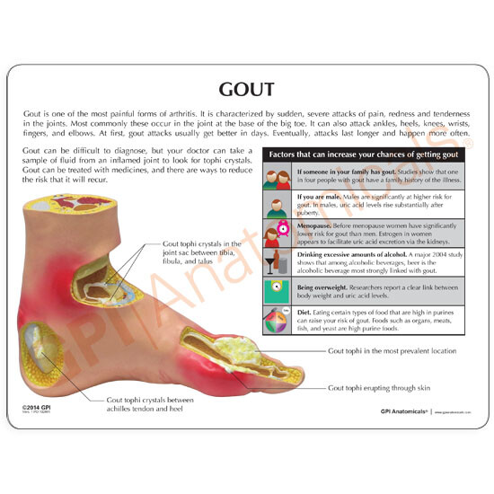 Foot Anatomical Model Gout Tophi GPI LFA #1985 SEE VIDEO