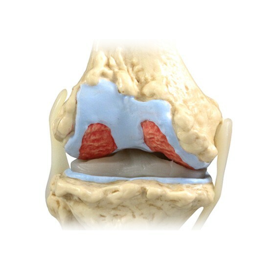 Knee 4-stage Osteoarthritis Anatomical Model LFA #1100 SEE VIDEO. Make An Offer!